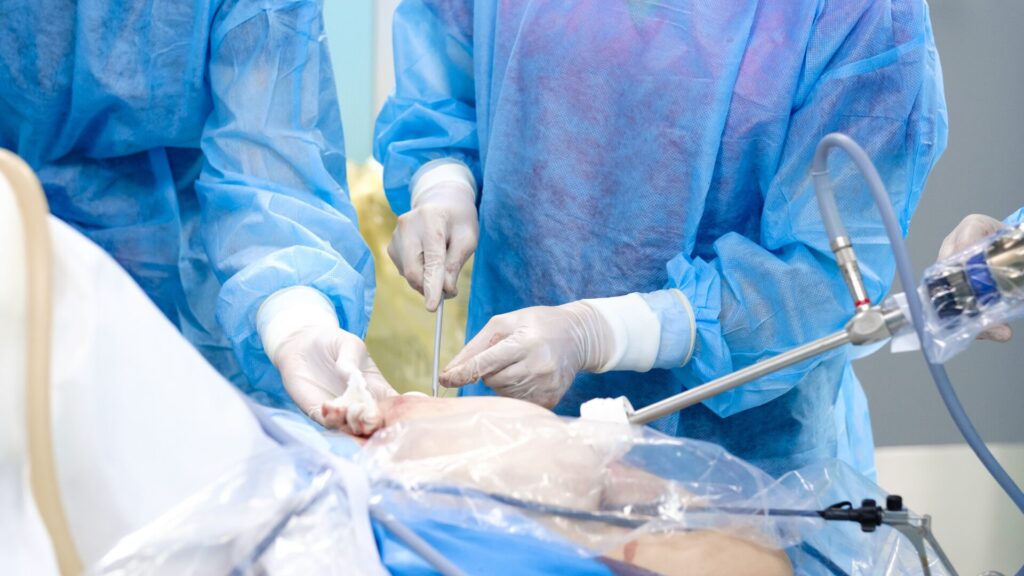 Minimally Invasive Surgery: Sacroiliac Joint Fusion Plano TX