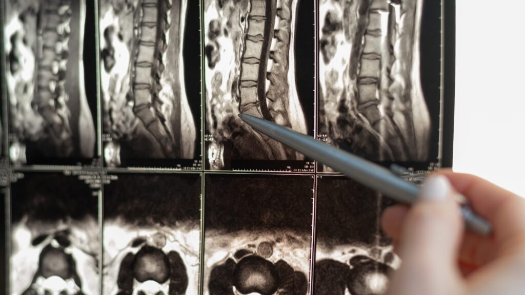 MIS for Degenerative Disc Surgery in Plano TX