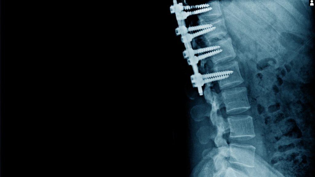 Spinal Stenosis Surgery Recovery