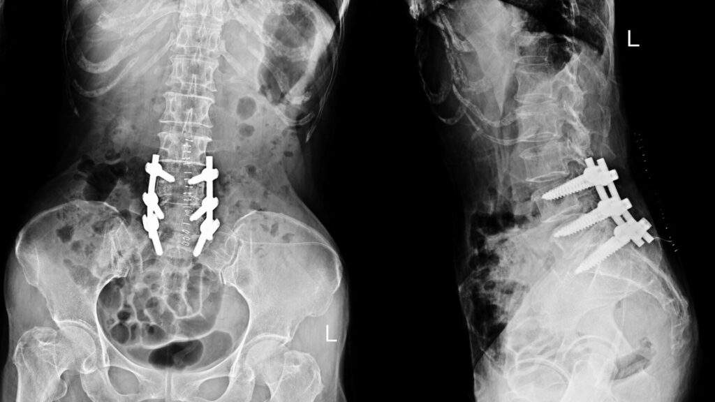What Is Cervical Laminectomy?